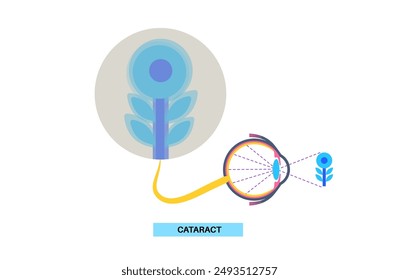 Cataract disease, eye and pupil anatomy. Lens clouding, vision impairment, and potential blindness. Vision problems during aging. Human vision loss concept. Blindness flat vector medical illustration