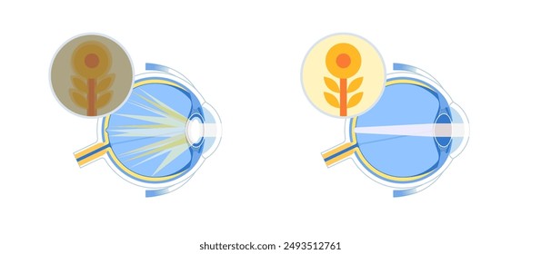 Cataract disease, eye and pupil anatomy. Lens clouding, vision impairment, and potential blindness. Vision problems during aging. Human vision loss concept. Blindness flat vector medical illustration