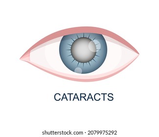 Cataract Eye Close Up View. Eyeball With Cloudy Lens. Anatomically Accurate Human Organ Of Vision With Aging Problems Isolated On White Background. Vector Realistic Illustration.