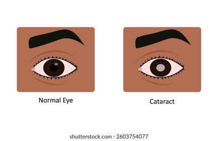 Cataract eye disease vector illustration