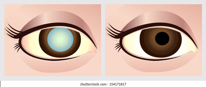 Cataract eye. File with clearly labeled layers for easy editing.
