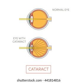 Cataract eye, vector. Human eye disorder