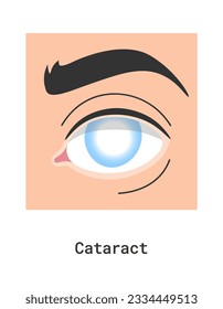 Cataract Ilustración de vectores de enfermedades oculares humanas