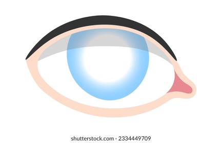 Cataract Ilustración de vectores de enfermedades oculares humanas