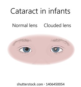 Cataract In Infants, Child, Kid. Clouded Lens And Normal. Vector Flat Medical Illustration.