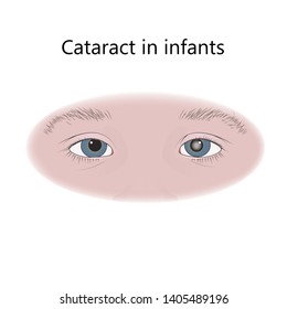 Cataract In Infants, Child, Kid. Vector Flat Medical Illustration.