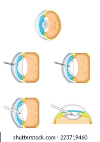 Cataract operation, showing a normal eye and a lens with a cataract.  The procedure for surgical removal is shown. Created in Adobe Illustrator.