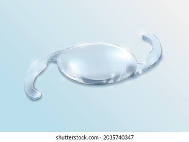 Cataract surgery, intraocular lens that will restore your vision. Corrective eyewear. Intraocular Lens Dislocation (IOL)