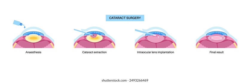 Proceso de cirugía de cataratas. Anestesia, incisión, extracción de cataratas e implantación de lente intraocular. Problemas del sistema de visión y tratamiento. Póster anatómico de la enfermedad del ojo humano Ilustración vectorial plana