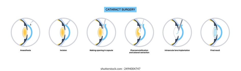 Cataract surgery process. Anesthesia, incision, cataract extraction and intraocular lens implantation. Vision system problem and treatment. Human eye disease anatomical poster flat vector illustration