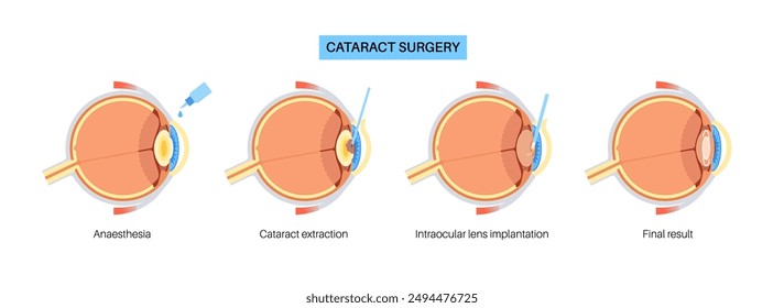 Cataract surgery process. Anesthesia, incision, cataract extraction and intraocular lens implantation. Vision system problem and treatment. Human eye disease anatomical poster flat vector illustration