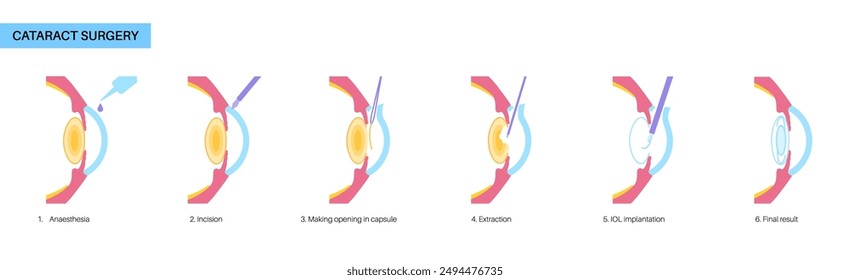 Cataract surgery process. Anesthesia, incision, cataract extraction and intraocular lens implantation. Vision system problem and treatment. Human eye disease anatomical poster flat vector illustration