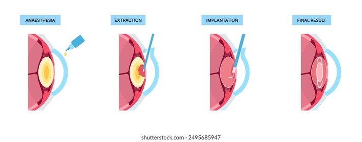 Proceso de cirugía de cataratas. Anestesia, incisión, extracción de cataratas e implantación de lente intraocular. Problemas del sistema de visión y tratamiento. Póster anatómico de la enfermedad del ojo humano Ilustración vectorial plana