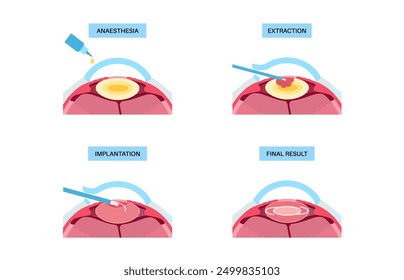 Cataract surgery process. Anesthesia, incision, cataract extraction and intraocular lens implantation. Vision system problem and treatment. Human eye disease anatomical poster flat vector illustration