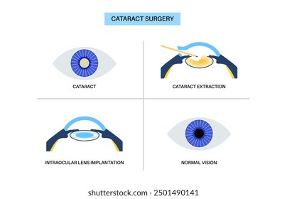 Cataract surgery process. Anesthesia, incision, cataract extraction and intraocular lens implantation. Vision system problem and treatment. Human eye disease anatomical poster flat vector illustration