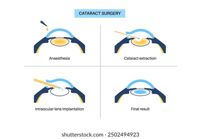 Proceso de cirugía de cataratas. Anestesia, incisión, extracción de cataratas e implantación de lentes intraoculares. Problema del sistema de visión y tratamiento. Ilustración vectorial plana del cartel anatómico de la enfermedad del ojo humano