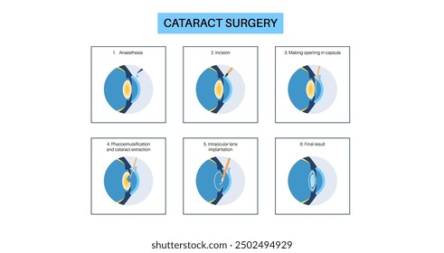 Cataract surgery process. Anesthesia, incision, cataract extraction and intraocular lens implantation. Vision system problem and treatment. Human eye disease anatomical poster flat vector illustration