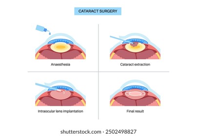 Cataract surgery process. Anesthesia, incision, cataract extraction and intraocular lens implantation. Vision system problem and treatment. Human eye disease anatomical poster flat vector illustration