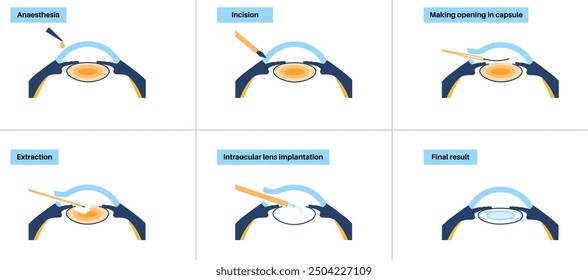 Cataract surgery process. Anesthesia, incision, cataract extraction and intraocular lens implantation. Vision system problem and treatment. Human eye disease anatomical poster flat vector illustration