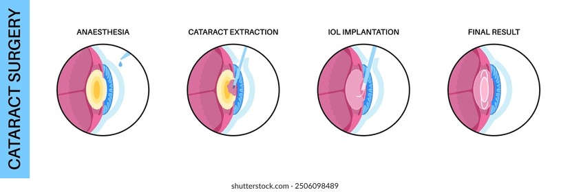 Cataract surgery process. Anesthesia, incision, cataract extraction and intraocular lens implantation. Vision system problem and treatment. Human eye disease anatomical poster flat vector illustration