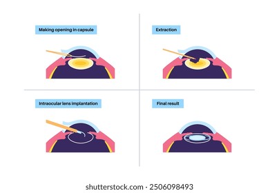 Cataract surgery process. Anesthesia, incision, cataract extraction and intraocular lens implantation. Vision system problem and treatment. Human eye disease anatomical poster flat vector illustration