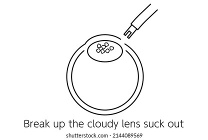 Cataract Surgery Process, Illustration (Line Drawing), Sucking Out the Cloudy Lens