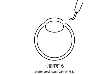 Cataract Surgery Process, Illustration (line drawing), Making an incision - Translation: Incision