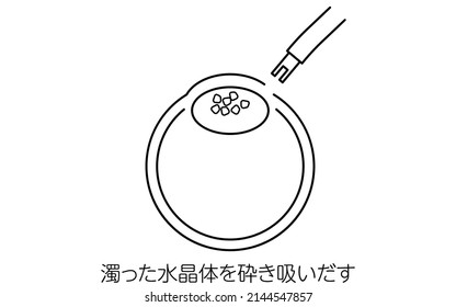 Proceso de Cirugía de Cataract, Ilustración (Plano de Línea), Succión de la lente nublada - Traducción: Extrayendo la lente nublada