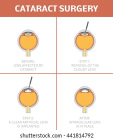 Cataract Surgery, Vector. Steps Of Procedure