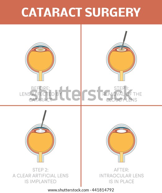 Cataract Surgery Vector Steps Procedure Stock Vector (Royalty Free ...