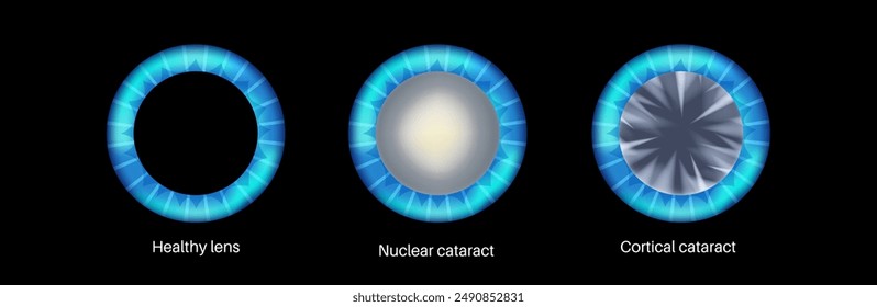 Cataract types poster, eye diseases concept. Lens clouding, vision impairment, and potential blindness. Vision problems during aging. Human vision loss concept. Blindness vector medical illustration