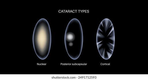 Cataract types poster, eye diseases concept. Lens clouding, vision impairment, and potential blindness. Vision problems during aging. Human vision loss concept. Blindness vector medical illustration