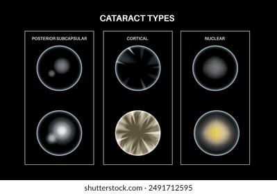 Cataract types poster, eye diseases concept. Lens clouding, vision impairment, and potential blindness. Vision problems during aging. Human vision loss concept. Blindness vector medical illustration