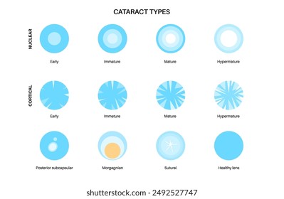 Cataract types poster, eye diseases concept. Lens clouding, vision impairment, and potential blindness. Vision problems during aging. Human vision loss concept. Blindness vector medical illustration