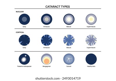 Katarakttypen Poster, Augenkrankheiten Konzept. Linsentrübung, Sehstörungen und potenzielle Blindheit. Sehstörungen während des Alterns. Konzept des menschlichen Sehverlustes. Blindheit, Vektorgrafik, Darstellung