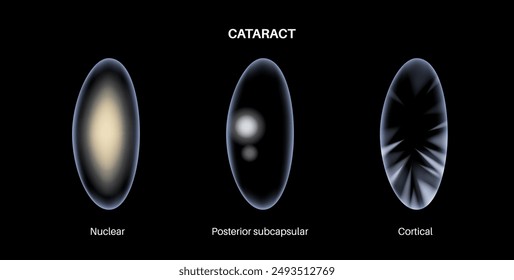 Cataract types poster, eye diseases concept. Lens clouding, vision impairment, and potential blindness. Vision problems during aging. Human vision loss concept. Blindness vector medical illustration
