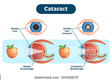 Cataract vector illustration diagram, anatomical scheme.  A cataract is a clouding of the lens in the eye which leads to a decrease in vision.