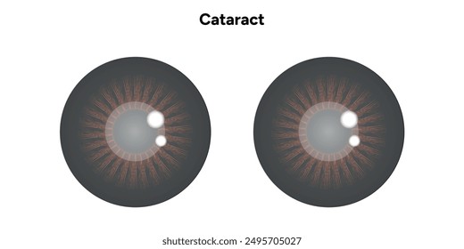 Cataract vision disorder problem eye with brown eye