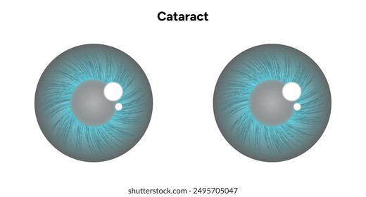 Cataract vision disorder problem eye with green eye