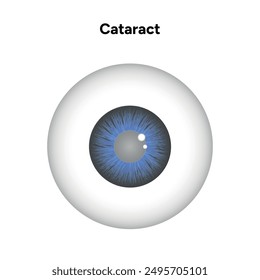 Cataract vision disorder problem eye with blue eye