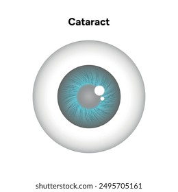 Cataract vision disorder problem eye with blue eye