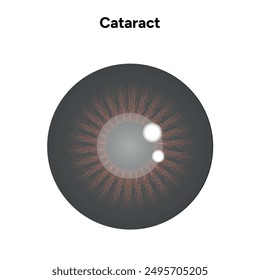 Cataract vision disorder problem eye with brown eye