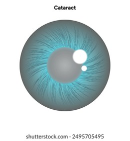 Cataract vision disorder problem eye with green eye