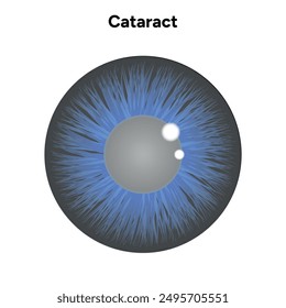 Cataract vision disorder problem eye with blue eye