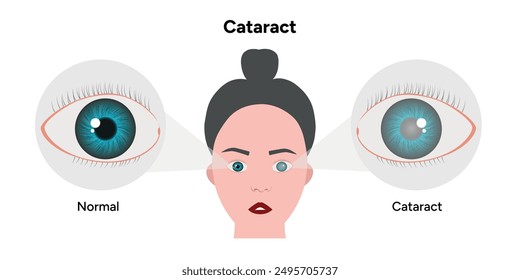 Cataract vision disorder problem eye and normal eye