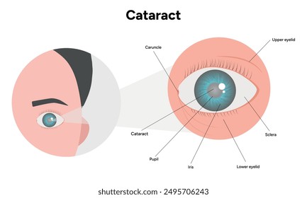 Cataract vision disorder problem eye zoom and human anatomy