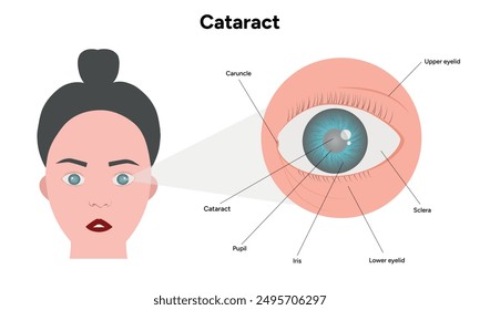 Cataract vision disorder problem eye and normal eye and human eye anatomy