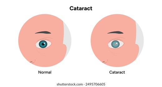 Cataract vision disorder problem eye and normal eye 