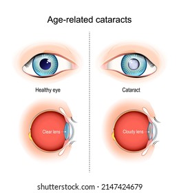 cataracts. Age-related vision problems. Cross-sectional view, showing the position of the human lens. vector illustration