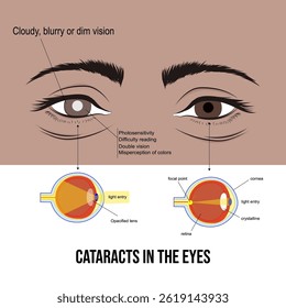 Cataracts, cloudiness in the eyes, blurred vision.